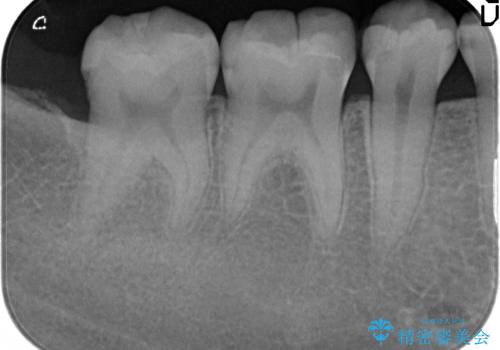 コンポジットレジン修復下で再発する虫歯の治療前