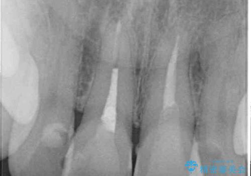 変色した前歯 オールセラミッククラウンにより審美歯科治療の治療前
