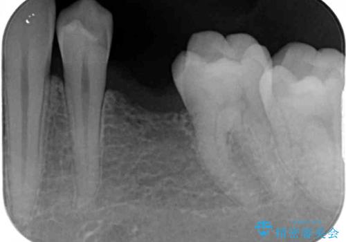 外れてしまった銀歯の詰め物 オールセラミックブリッジにて審美補綴の治療前