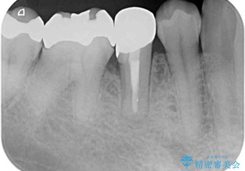 穴を開けられ抜歯となった奥歯 セラミックブリッジによる補綴治療の治療前