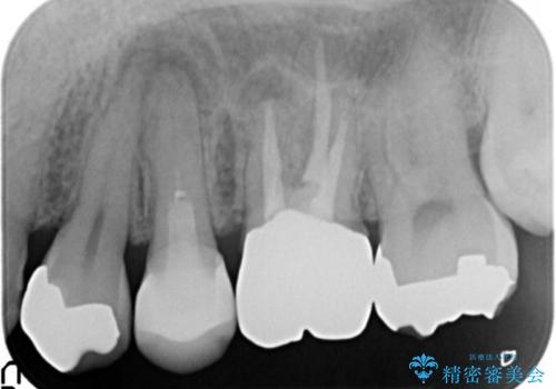 セラミックインレーと根管治療を伴うセラミッククラウンの治療前
