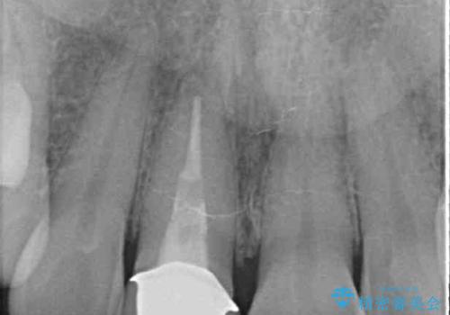 目立つ前歯の詰め物 オーダーメイドのセラミッククラウンで審美的に仕上げるの治療前