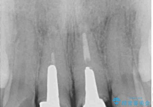 変色した前歯のクラウン オールセラミッククラウンにより審美歯科治療の治療前