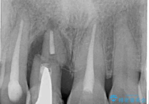 治療途中で放置した前歯 オールセラミックブリッジの治療前