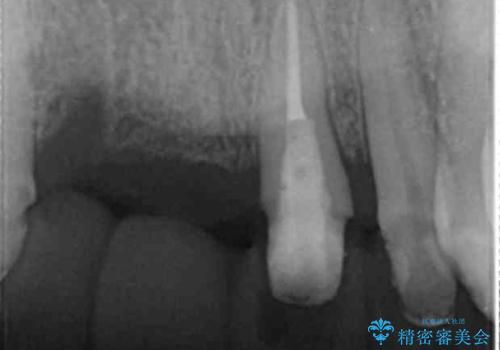 前歯が折れた 前歯部審美セラミックブリッジ治療の治療中