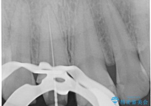 前歯1本だけ色が違う:他の歯となじむ被せ物で自然な仕上がりにの治療中