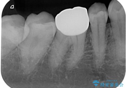 銀歯を白くしたい:適合の良い被せ物で長期間安心して使える歯にの治療後