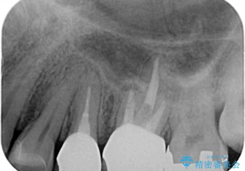 セラミックインレーと根管治療を伴うセラミッククラウンの治療後