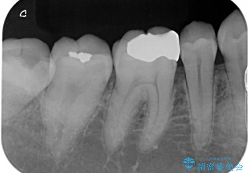 銀歯を白くしたい:適合の良い被せ物で長期間安心して使える歯にの治療前