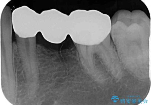 外れてしまった銀歯の詰め物 オールセラミックブリッジにて審美補綴の治療後