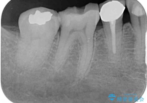 欠けてしまった奥歯 セラミッククラウンによる補綴治療の治療前