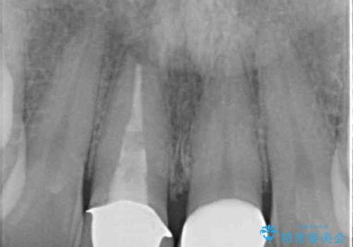 目立つ前歯の詰め物 オーダーメイドのセラミッククラウンで審美的に仕上げるの治療後