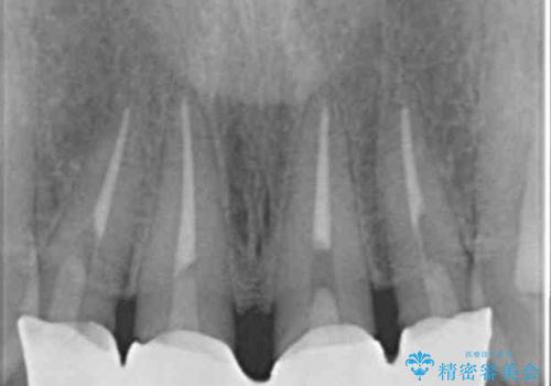 美容外科による不自然なかぶせもので、前歯がコンプレックスに。自然なセラミックにやりかえ 30代女性の治療前