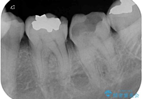 銀歯や虫歯を治したい ゴールドインレーによるむし歯治療の治療前