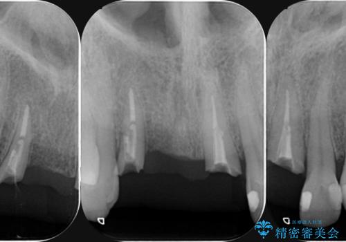 前歯が折れた 前歯部審美セラミックブリッジ治療の治療前