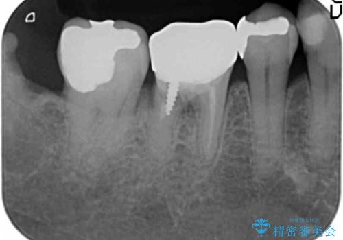 奥歯 抜歯してブリッジに 50代女性の治療前
