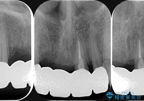 前歯が折れた 前歯部審美セラミックブリッジ治療の治療後