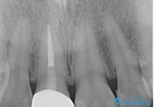前歯1本だけ色が違う:他の歯となじむ被せ物で自然な仕上がりにの治療後