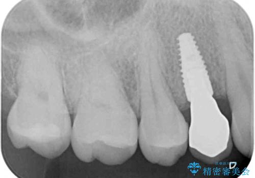 深い虫歯の歯を抜歯 目立つ小臼歯のインプラント治療の治療後