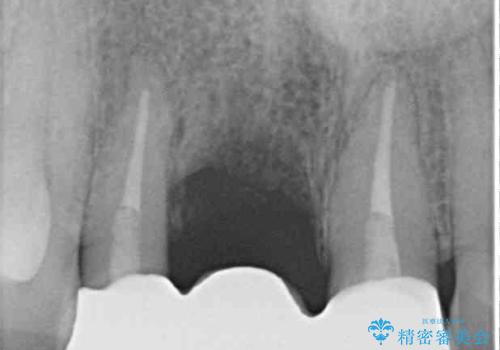 治療途中で放置した前歯 オールセラミックブリッジの治療後
