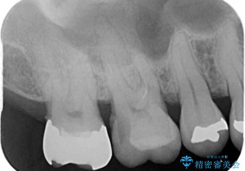 銀歯や虫歯を治したい　ゴールドインレーによるむし歯治療の治療前