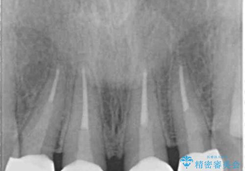 美容外科による不自然なかぶせもので、前歯がコンプレックスに。自然なセラミックにやりかえ 30代女性の治療後