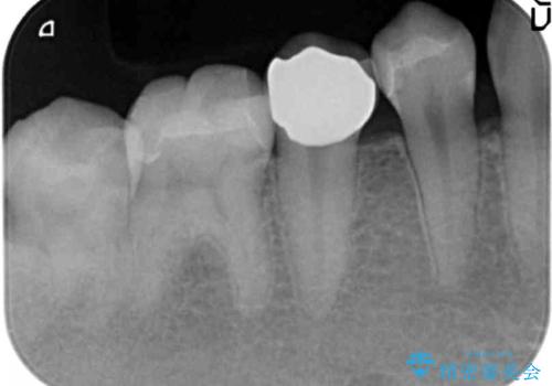 コンポジットレジン修復下で再発する虫歯の治療後