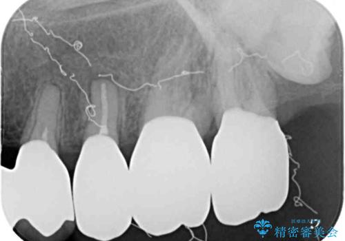 歯肉が腫れて出血する 奥歯の歯周病治療の治療後