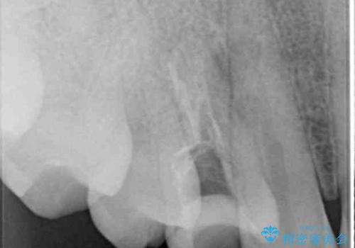 深い虫歯の歯を抜歯　目立つ小臼歯のインプラント治療の治療前
