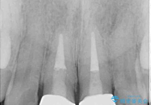 変色した前歯のクラウン オールセラミッククラウンにより審美歯科治療の治療後