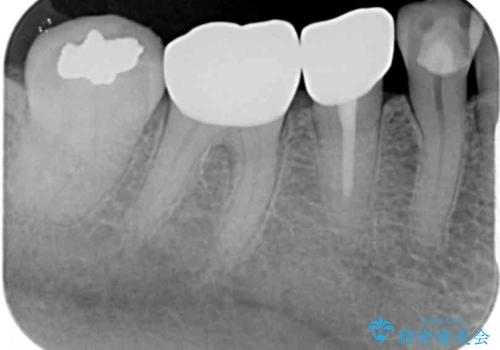 欠けてしまった奥歯 セラミッククラウンによる補綴治療の治療後