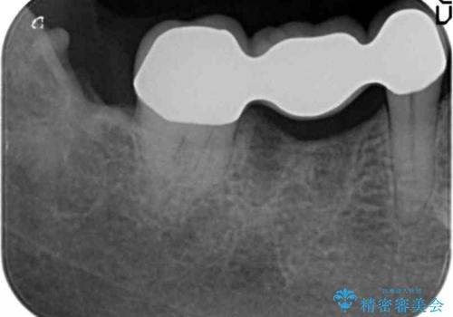 奥歯 抜歯してブリッジに 50代女性の治療後