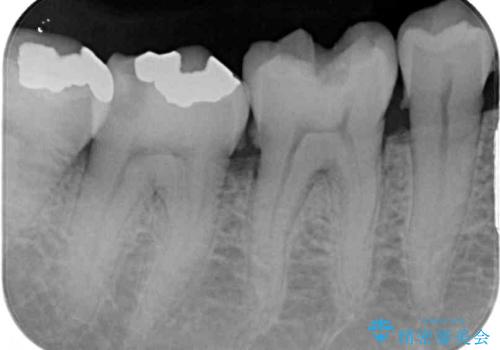 銀歯や虫歯を治したい ゴールドインレーによるむし歯治療の治療前