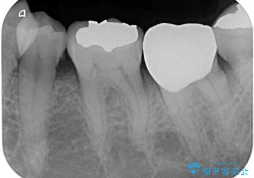 銀歯や虫歯を治したい ゴールドインレーによるむし歯治療の治療後