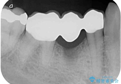 穴を開けられ抜歯となった奥歯　セラミックブリッジによる補綴治療の治療後