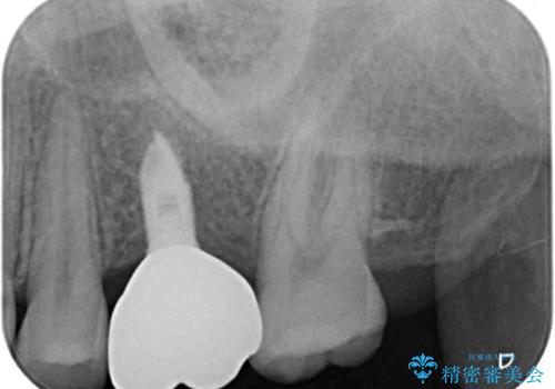 インプラントによる補綴治療とインビザライン矯正の治療後