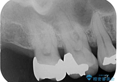 銀歯や虫歯を治したい　ゴールドインレーによるむし歯治療の治療後