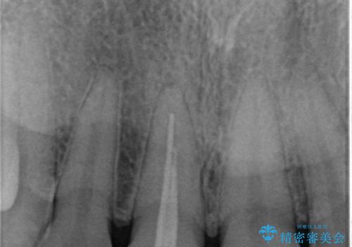 前歯1本だけ色が違う:他の歯となじむ被せ物で自然な仕上がりにの治療前