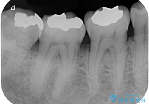 銀歯や虫歯を治したい ゴールドインレーによるむし歯治療の治療後