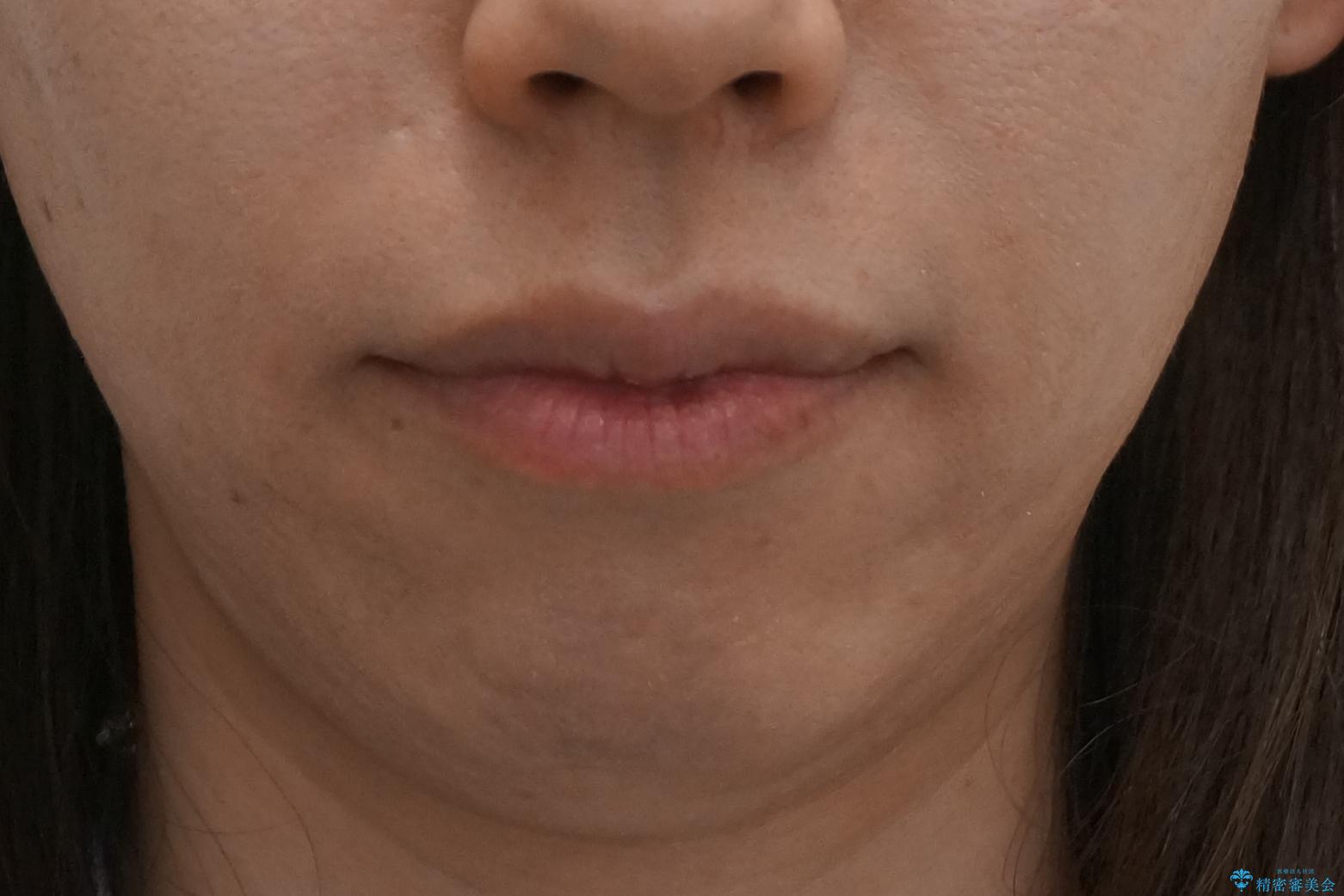 出っ歯 前歯のがたがた 口元を引っ込めたいの治療後(顔貌)