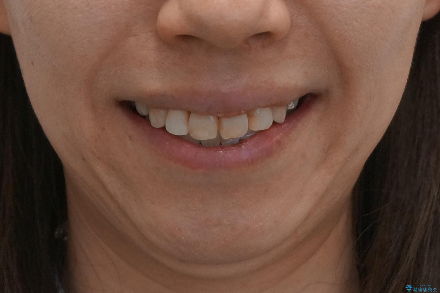 出っ歯　前歯のがたがた　口元を引っ込めたいの治療後（顔貌）