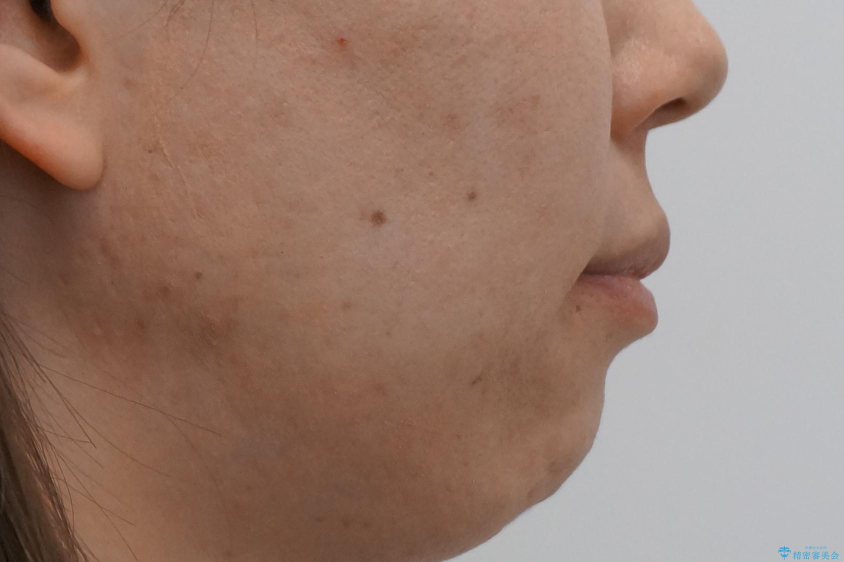 出っ歯 前歯のがたがた 口元を引っ込めたいの治療後(顔貌)