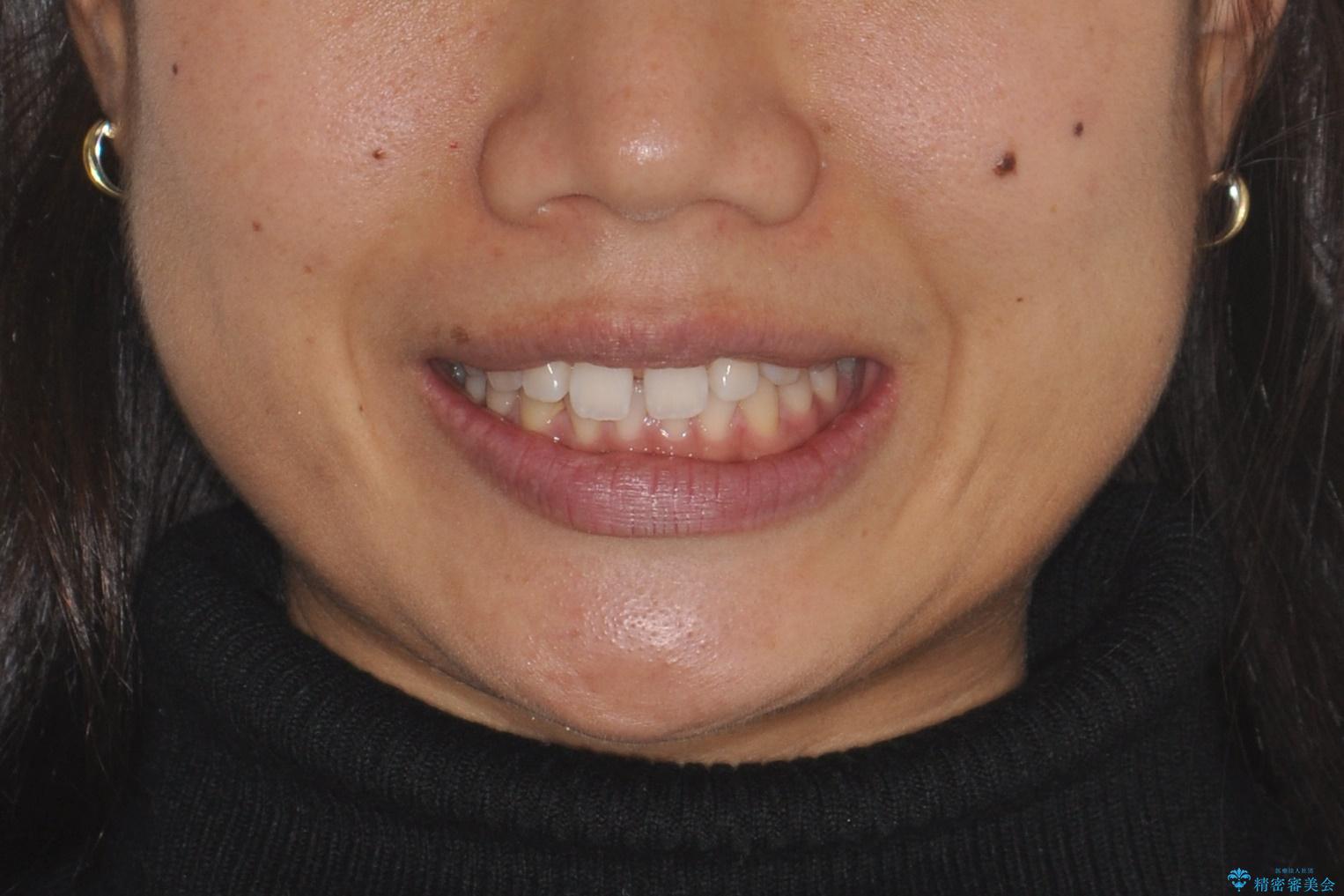すきっ歯のインビザラインによる目立たない矯正の治療前（顔貌）
