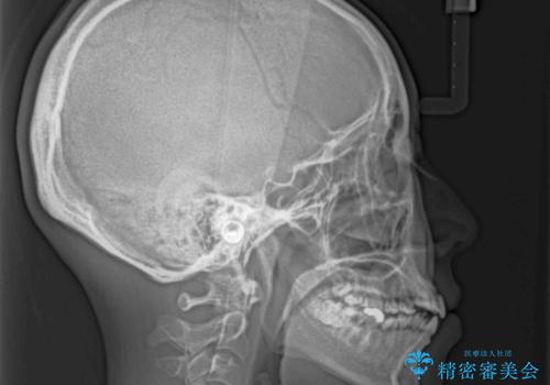 口元の突出感を改善 インビザラインによる非抜歯矯正の治療前