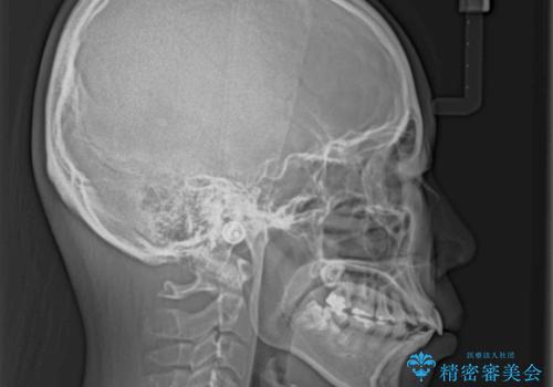 部分矯正で出っ歯になった 出っ歯改善の抜歯矯正の治療前