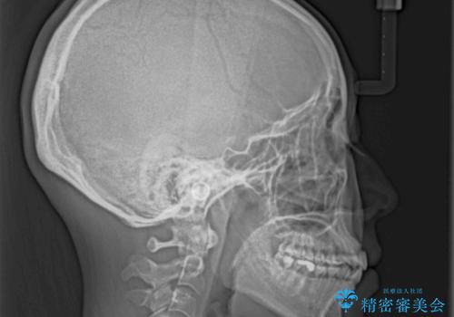 口元の突出感を改善 インビザラインによる非抜歯矯正の治療後