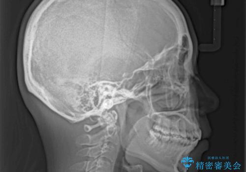 口元をスッキリと ワイヤー装置による抜歯矯正の治療後