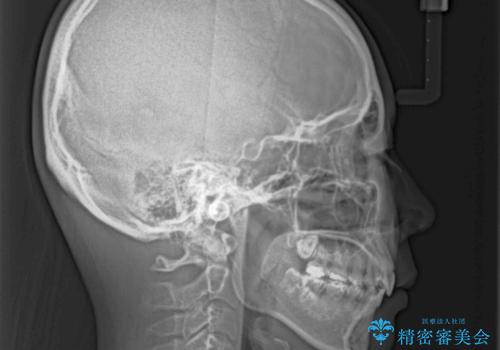 部分矯正で出っ歯になった 出っ歯改善の抜歯矯正の治療後