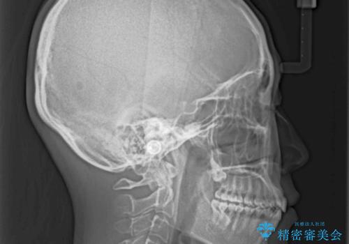 前歯の叢生とオープンバイト インビザラインでの矯正治療の治療後