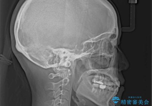 【モニター】幅の狭い上顎歯列 骨幅を拡大する矯正治療の治療後